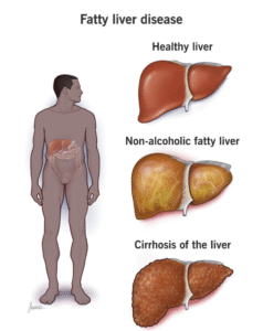 liver fun dr abhijeet kumar physiotherapist