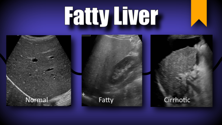 fatty liver dr abhijeet kumar physiotherapist
