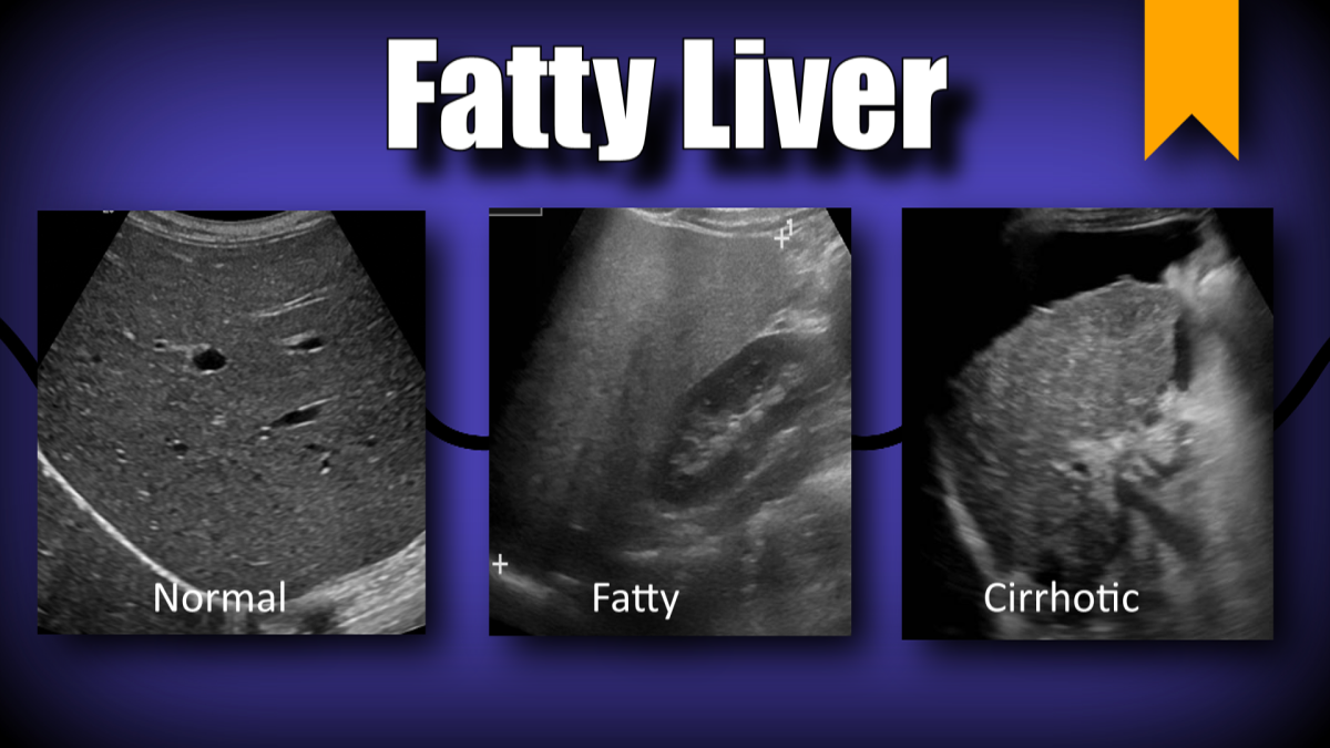 fatty liver dr abhijeet kumar physiotherapist